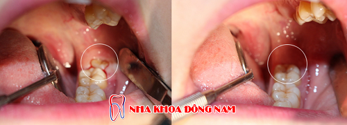 nhổ răng khôn hàm dưới mọc ngầm