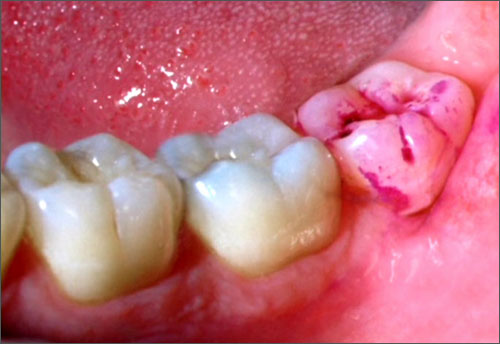 Nhổ răng có đau không tại nha khoa Kim, có biến chứng không?