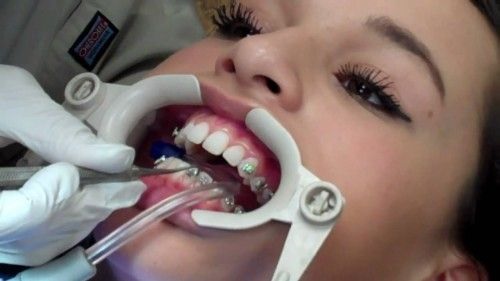 quy trình niềng răng