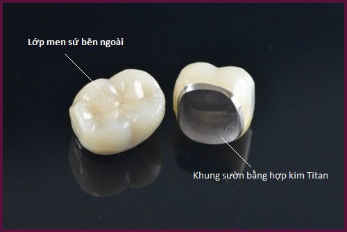 Image result for răng sứ titan