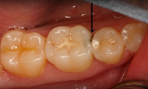 bệnh sâu răng 1