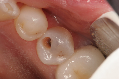 bệnh sâu răng 2