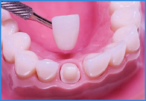 răng bọc sứ rồi có niềng răng được không 1