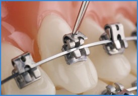 răng bọc sứ rồi có niềng răng được không 2