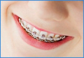 răng bọc sứ rồi có niềng răng được không 3