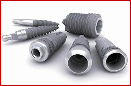 cấy ghép implant hàn quốc có tốt không 1