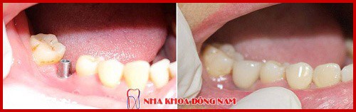 cấy ghép implant hàn quốc có tốt không 10