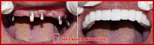 cấy ghép implant hàn quốc có tốt không 7