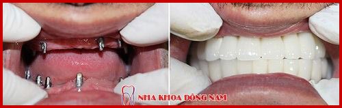 cấy ghép implant hàn quốc có tốt không 8