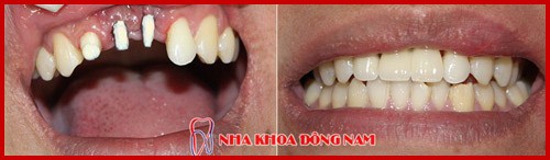 cấy ghép implant hàn quốc có tốt không 9
