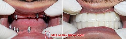 cay-implant-my-gia-bao-nhieu