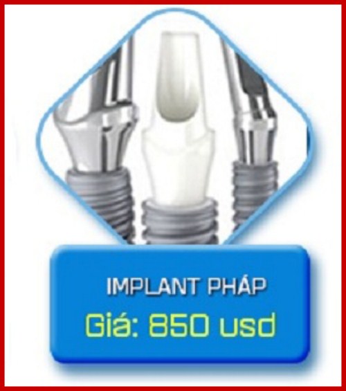chi phí trồng răng implant pháp giá bao nhiêu 2