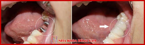 chi phí trồng răng implant pháp giá bao nhiêu 3