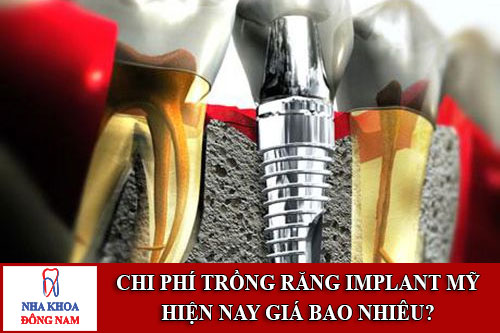 chi phí trồng răng implant mỹ hiện nay giá bao nhiêu
