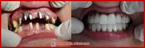 phương pháp cấy ghép implant bằng implant pháp có tốt không 3