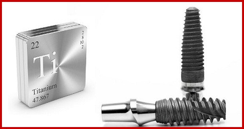 phương pháp cấy ghép implant bằng implant pháp có tốt không 4