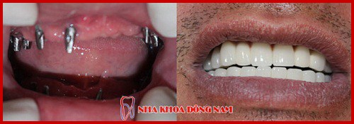 phương pháp cấy ghép implant bằng implant pháp có tốt không 5
