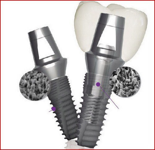 phương pháp cấy ghép implant mỹ có tốt không 3