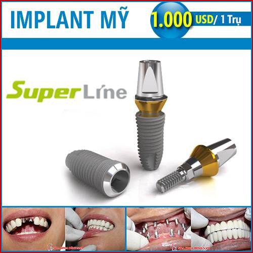 phương pháp cấy ghép implant mỹ 6có tốt không