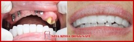 phương pháp cấy ghép implant mỹ có tốt không 7