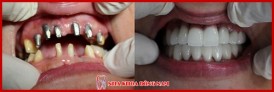 phương pháp cấy ghép implant mỹ có tốt không 9