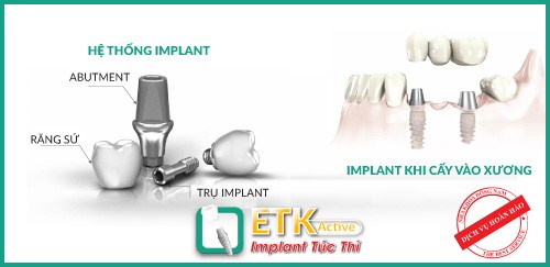 những ưu điểm vượt bậc của implant etk active 5