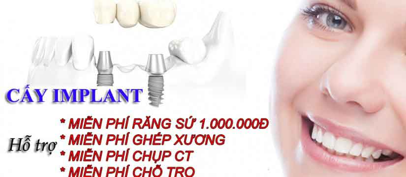 cấy ghép răng implant