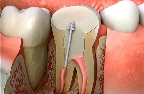 điều trị tủy răng
