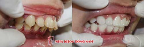 bọc răng sứ 2 hàm điều trị răng bị chìa