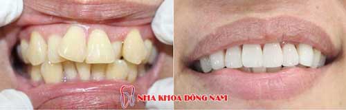 bọc răng sứ hàm trên mọc lộn xộn