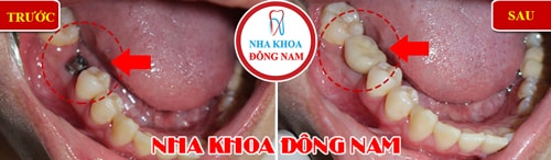Cấy Ghép Răng Implant hàm dưới