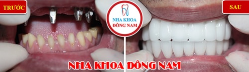 Cấy ghép Implant hàm trên phục hình 2 hàm sứ