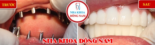 Cắm ghép Implant 2 hàm răng mất