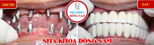 Cấy ghép Implant 2 hàm cho trường hợp mất răng toàn hàm