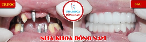 Cấy ghép Implant phục hình 2 hàm sứ