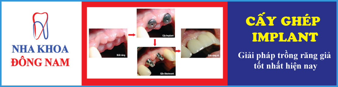 Cấy ghép răng implant