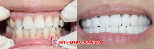 bọc 2 hàm răng sứ emax và titan 05082016