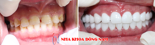 Bọc 2 hàm răng sứ cho răng bị thưa và ố vàng