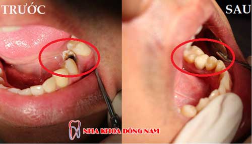 bọc răng sứ 1