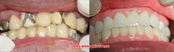 bọc răng sứ 10