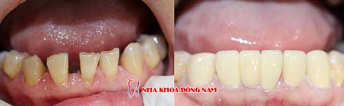bọc răng sứ 11