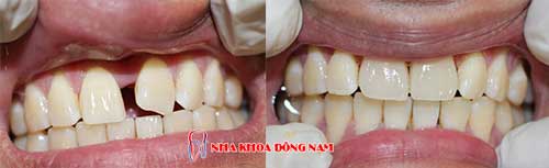 bọc răng sứ 13