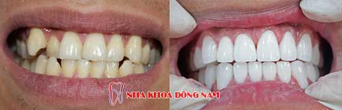 bọc răng sứ 2 hàm 2