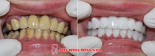 bọc răng sứ 2 hàm bị nhiểm kháng sinh
