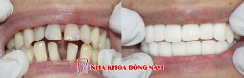 bọc răng sứ 2 hàm bị thưa