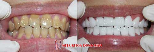 bọc răng sứ 2 hàm nhiễm kháng sinh