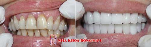 bọc răng sứ 2 hàm bị ố vàng và khuyết cổ