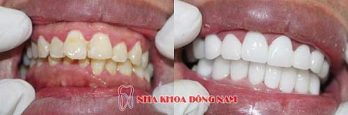 bọc răng sứ 2 hàm zirconia và titan