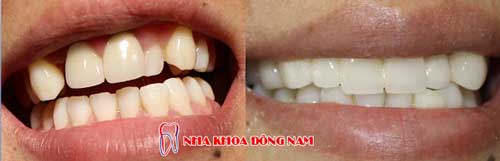 bọc răng sứ 2