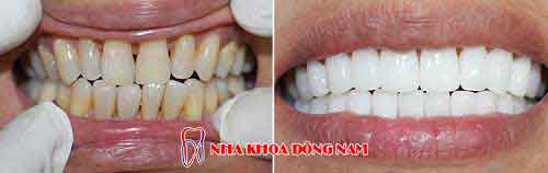 bọc răng sứ 22 cái zirconia